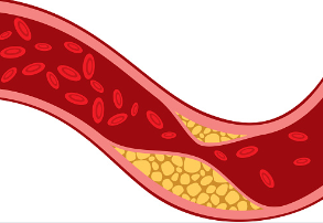 Kolesterol tinggi jika dibiarkan boleh mencetuskan penyakit arteri koronari