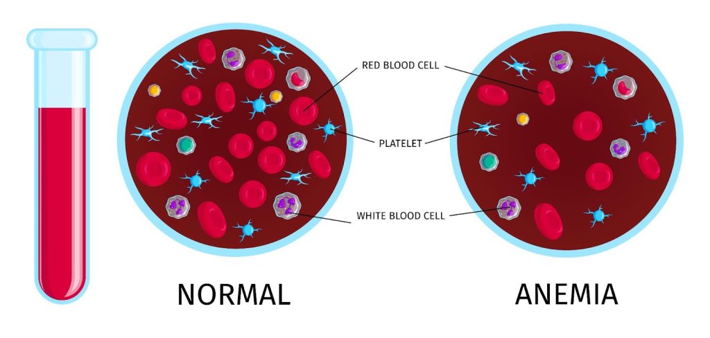 Dikatakan kekurangan darah apabila jumlah hemoglobin di bawah purata.