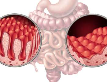 Fistula anus memiliki dampak yang signifikan pada individu yang mengalaminya. 